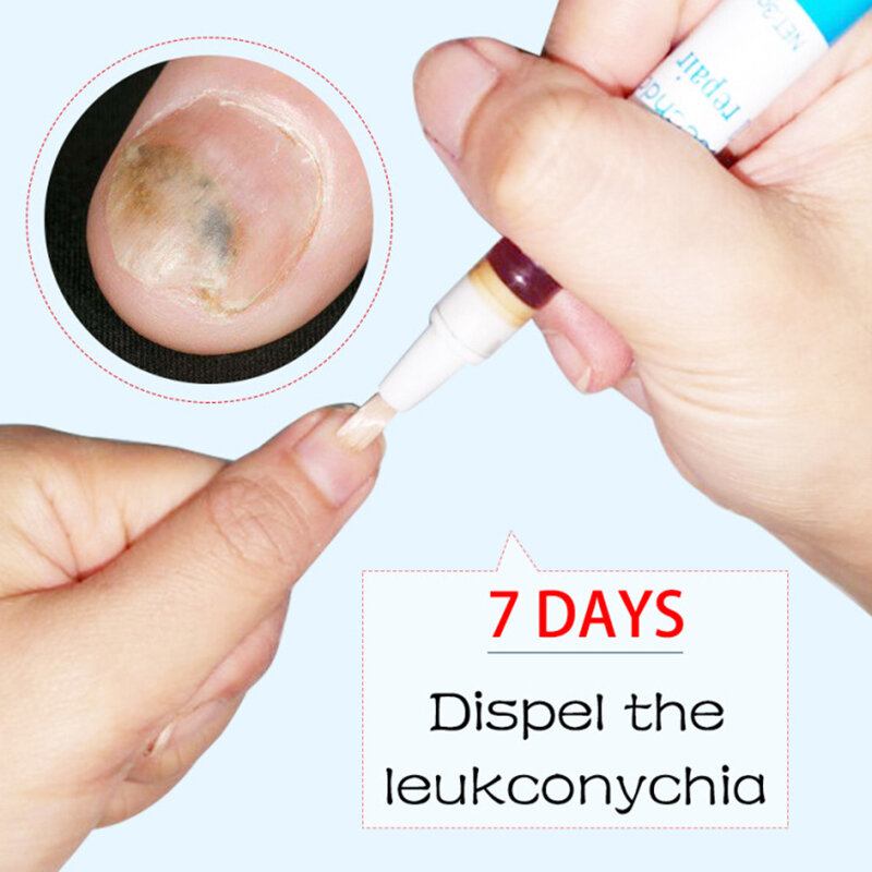 3ml Λάδι Επιδιόρθωσης Ονυχομυκητίασης Θεραπείας Μυκήτων Νυχιών Πέννα Για Ανάπτυξη Κατά Των Μυκητιακών Λοιμώξεων Υγρό Αφαίρεσης Επιδερμίδας